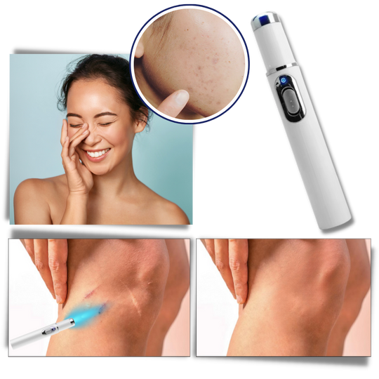 Draagbare Lasertherapie voor een Stralende Teint 1
