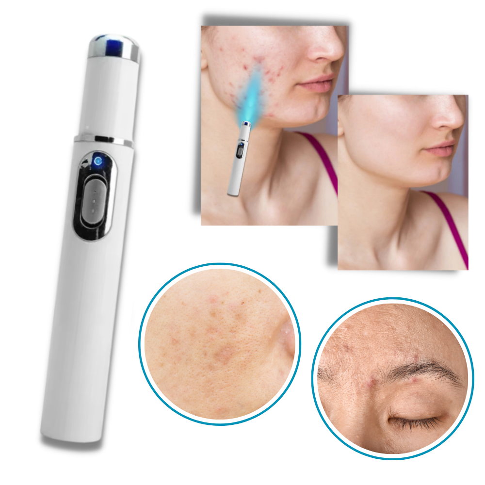 Draagbare Lasertherapie voor een Stralende Teint 4