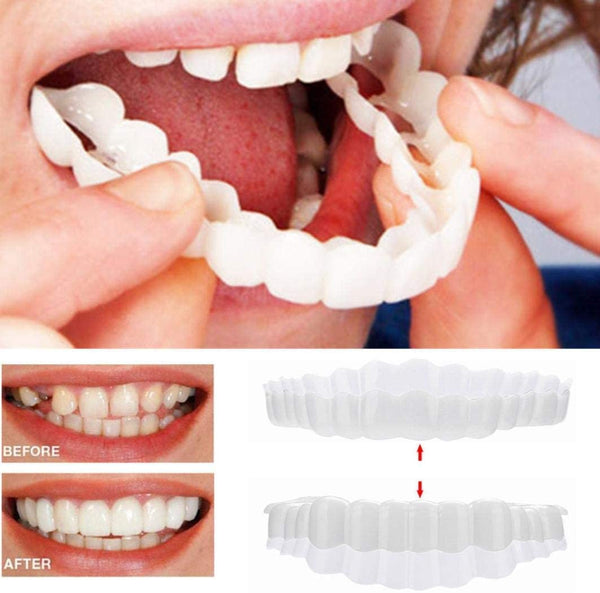 Over Smile Fineer Set voor Perfecte Glimlach 0