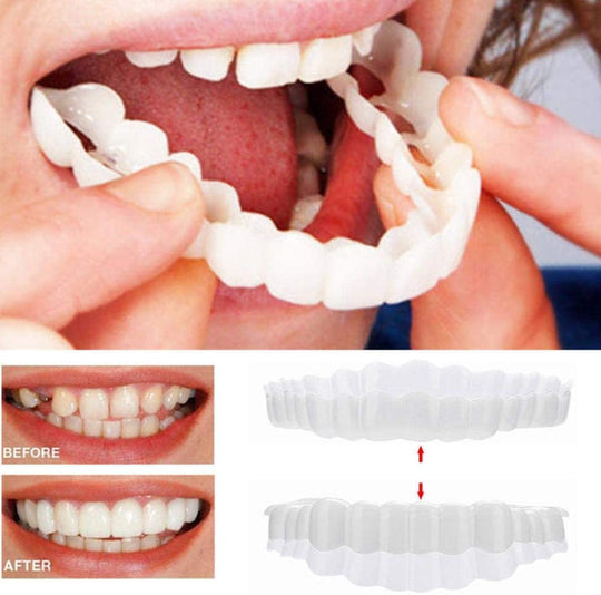Over Smile Fineer Set voor Perfecte Glimlach 0